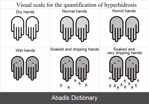 عکس هایپرهیدروز کف دست