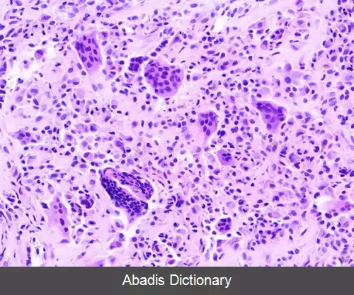 عکس تومور سلول ژانت در غلاف تاندون