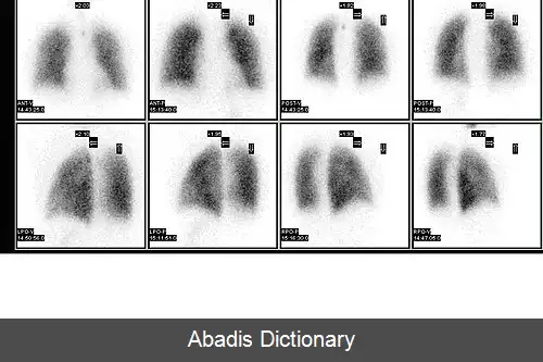 عکس اسکن های ریوی در پزشکی هسته ای