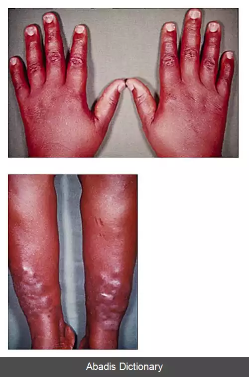 عکس درموپاتی گریوز