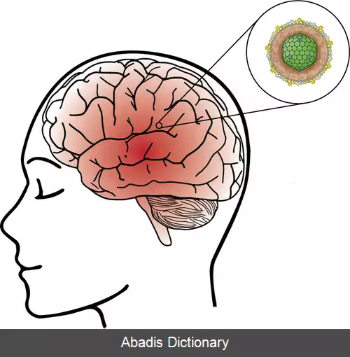 عکس انسفالیت ویروسی