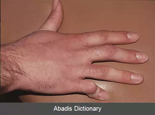عکس کژانگشتی