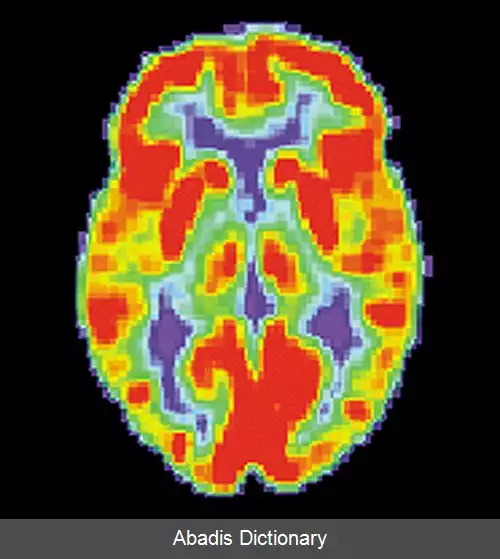 عکس برش نگاری گسیل پوزیترون مغز