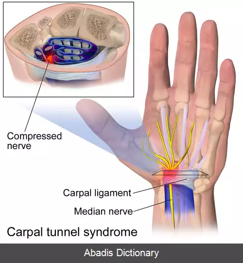 عکس جراحی تونل مچ دست