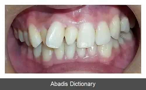 عکس دندان اضافه
