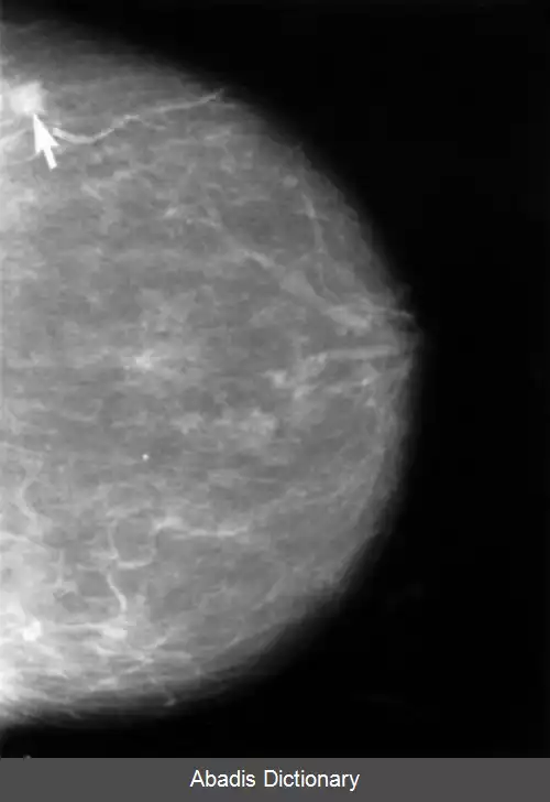 عکس ماموگرافی