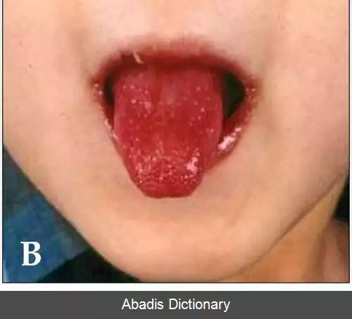 عکس سندروم کاوازاکی
