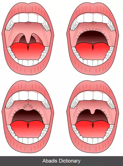 عکس یو پی تری