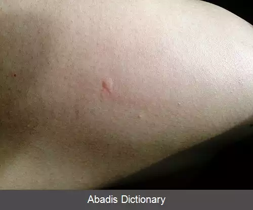 عکس قلم حرارتی (پزشکی)