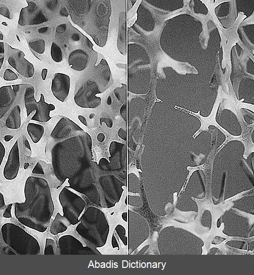 عکس نمره استخوان ترابکولار