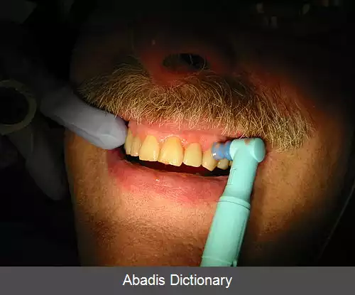 عکس تمیز کردن دندان ها