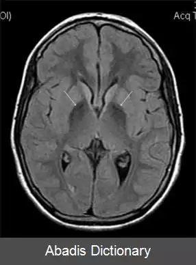 عکس آسرولوپلاسمینمی