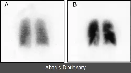 عکس اسکن های ریوی در پزشکی هسته ای