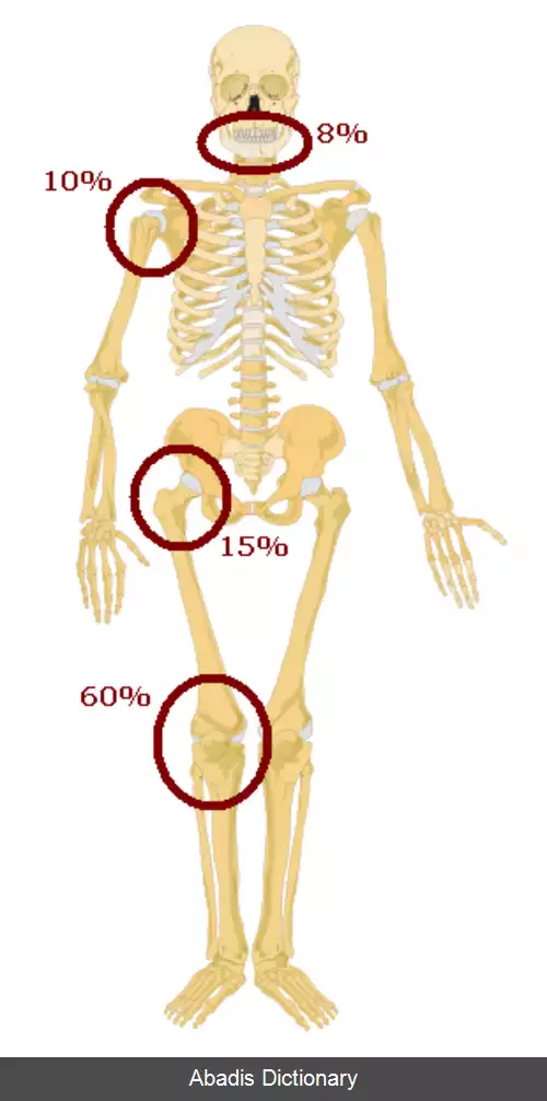 عکس استئوسارکوما