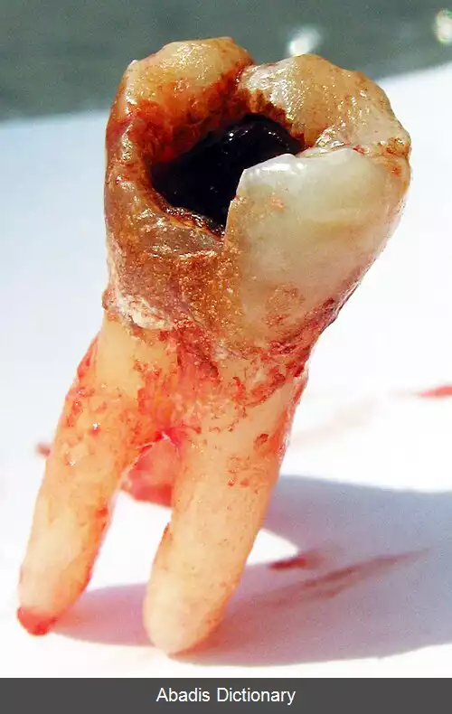 عکس آسیب شناسی دندان