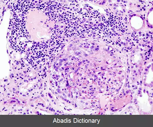 عکس گلومرولونفریت سریع پیشرونده