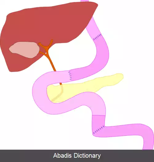 عکس گاسترکتومی