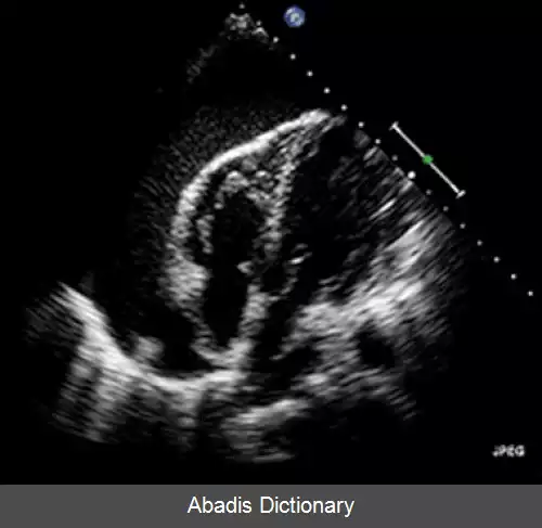 عکس افیوژن پریکارد